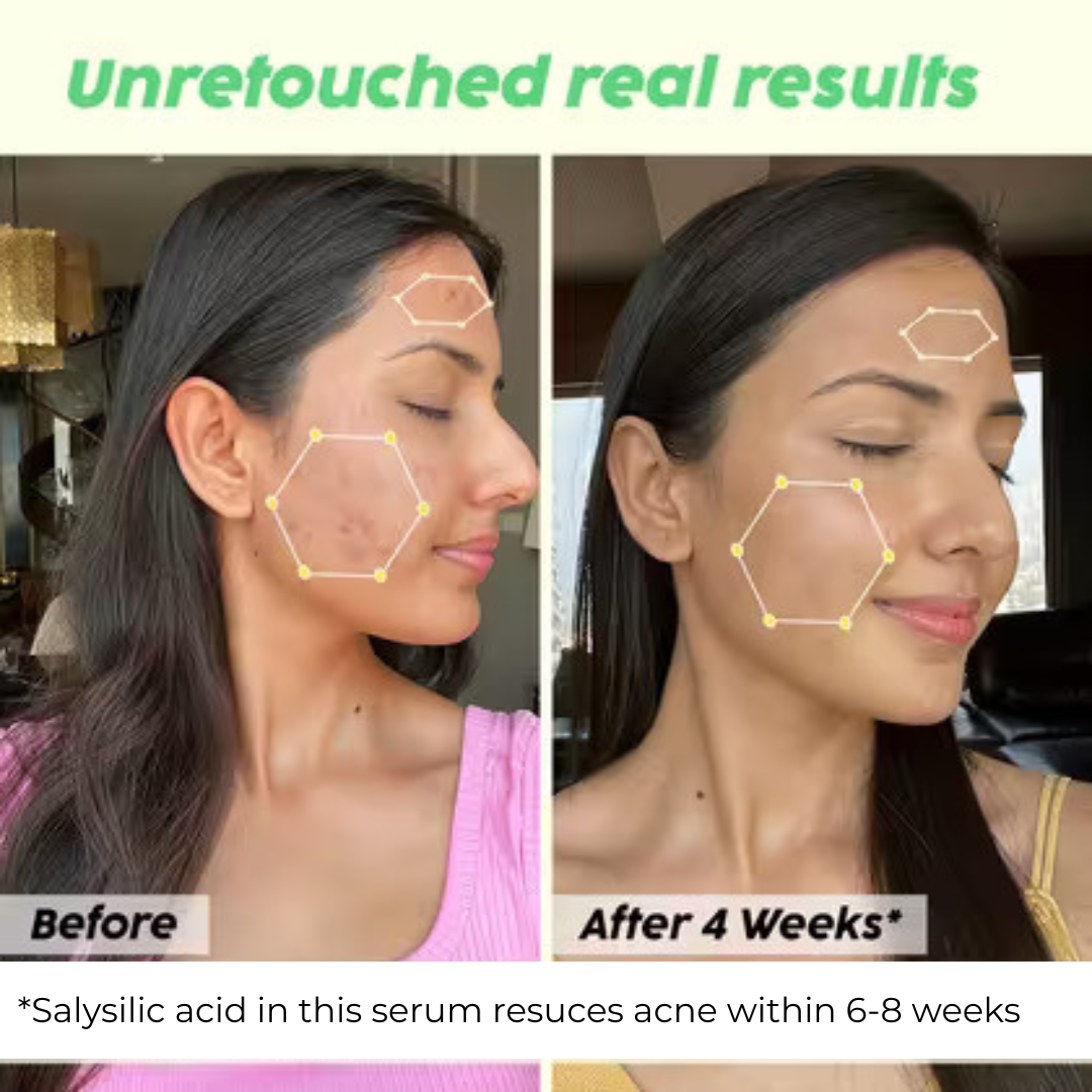 Skin Reborn - #1 Acne Controlling Serum + Free Lip Scrub