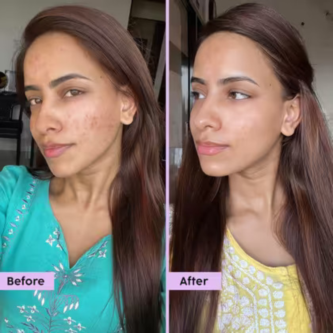 Skin Reborn - #1 Acne Controlling Serum + Free Lip Scrub