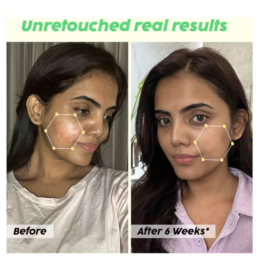 Skin Reborn - #1 Acne Controlling Serum + Free Lip Scrub