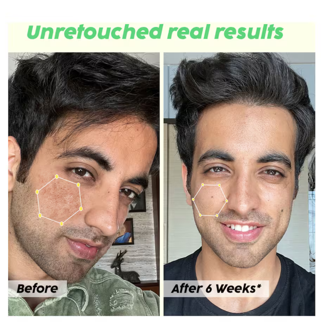 Skin Reborn - #1 Acne Controlling Serum + Free Lip Scrub