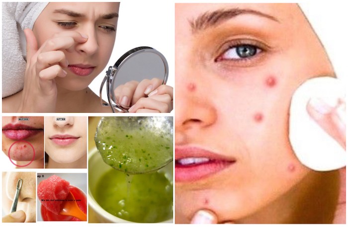 7 Remedies to Get Rid of Blind Pimples