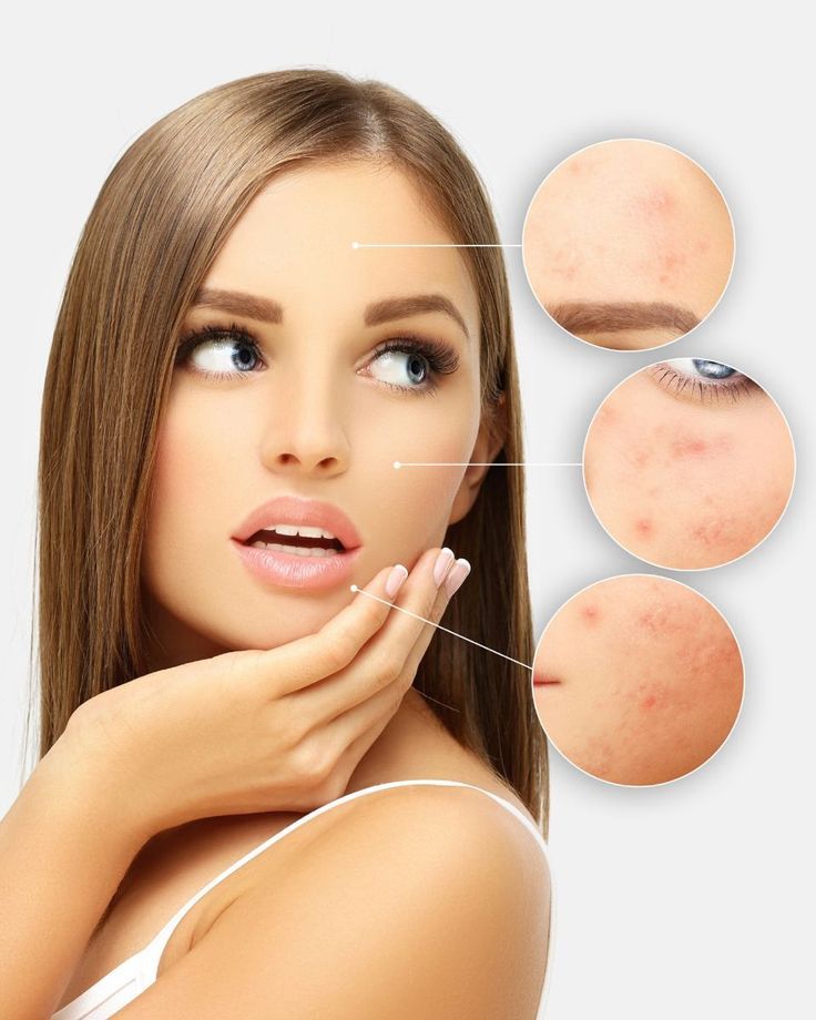 Monsoon Skincare Tips for Oily and Acne-Prone Skin