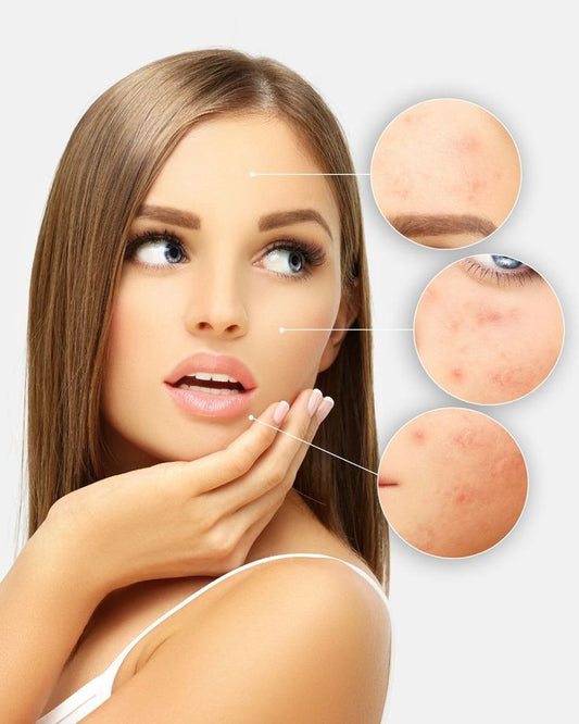 Monsoon Skincare Tips for Oily and Acne-Prone Skin