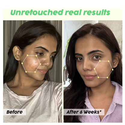 Skin Reborn - #1 Acne Controlling Serum + Free Lip Scrub